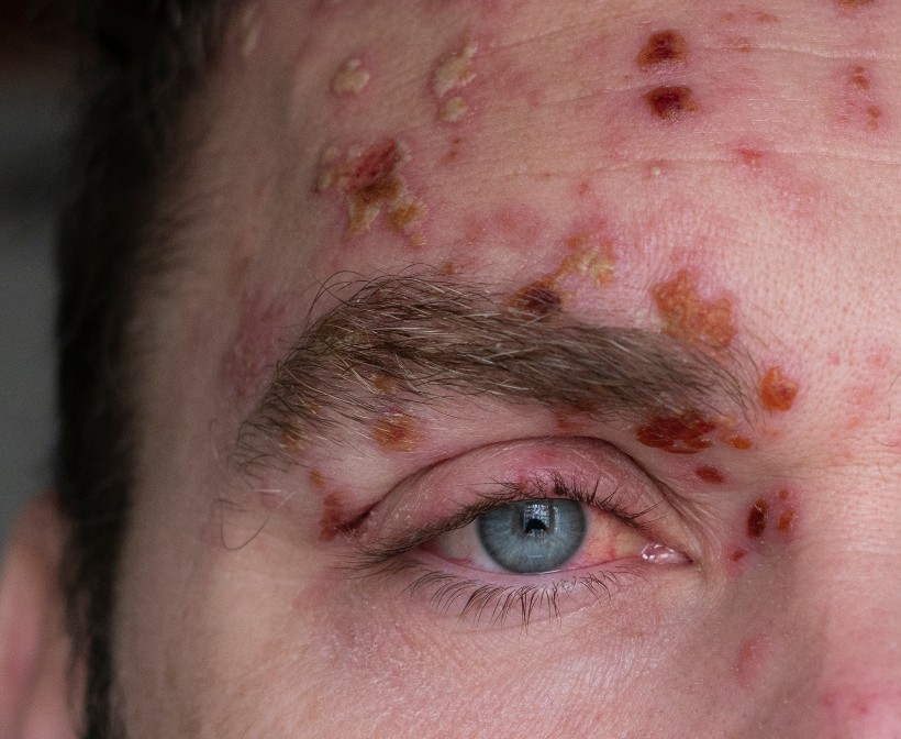 Nahaufnahme eines Auges, welches mit Herpes Zoster befallen ist