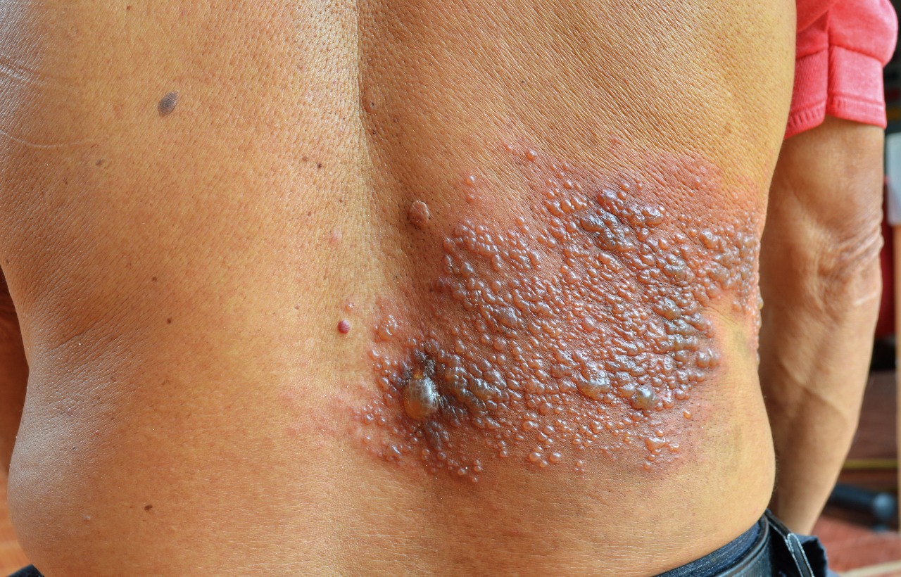 Mann mit Herpes Zoster Bläschen auf dem Rücken