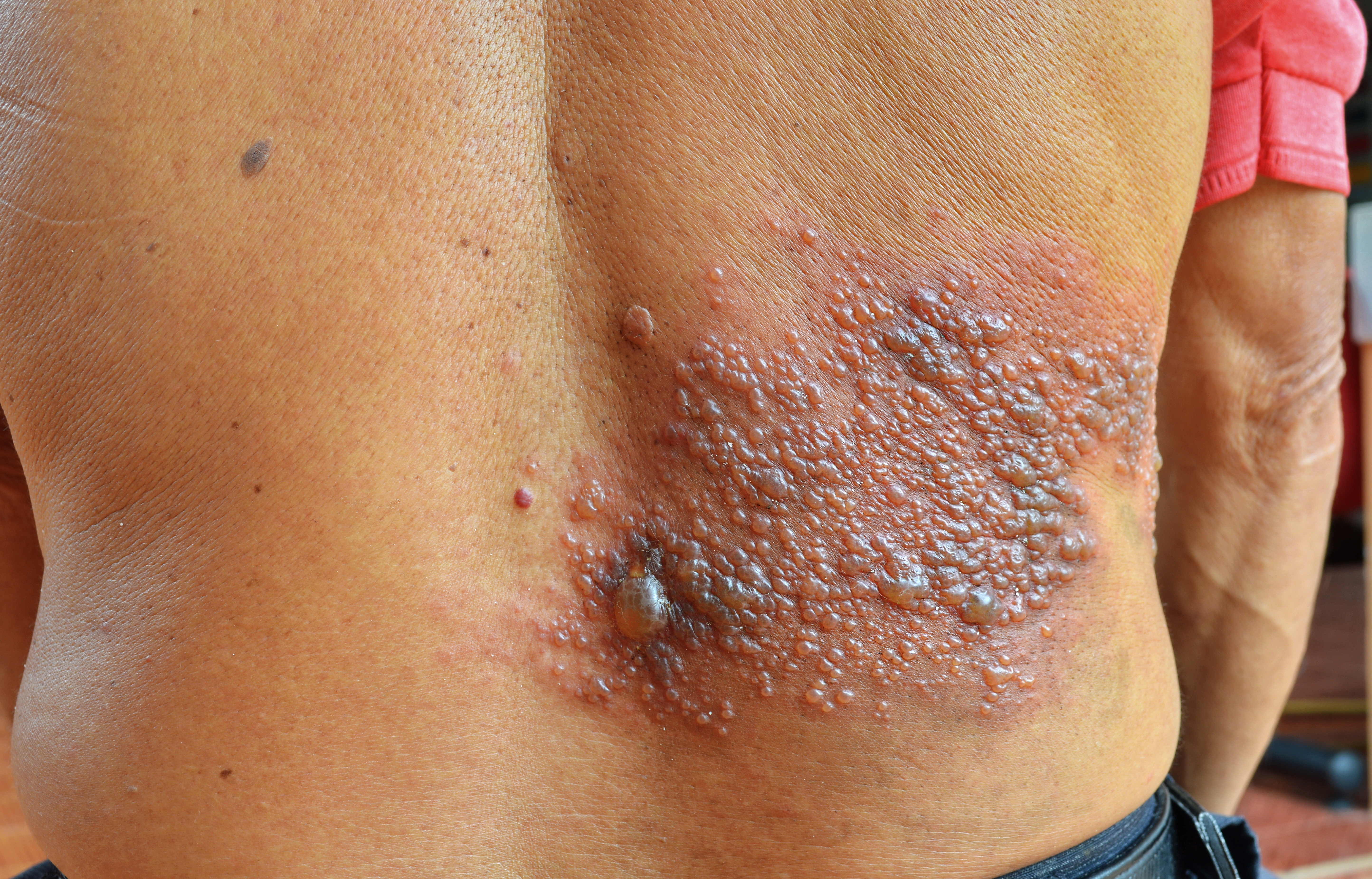Mann mit Herpes Zoster Bläschen auf dem Rücken